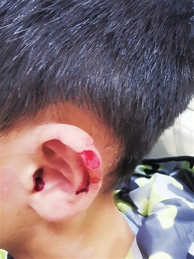 孩子耳朵被剪破。 牛女士供图